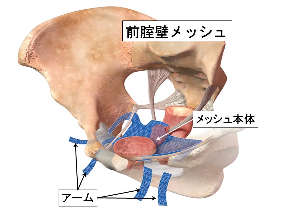 メッシュ手術イラスト